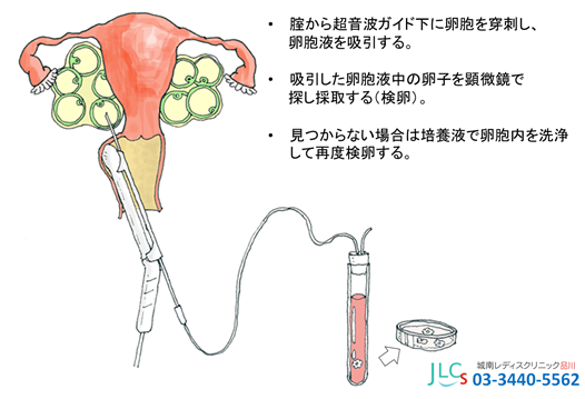 採卵 後 張り いつまで